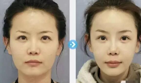 除皱抗衰老前后对比图