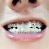 牙齿排列不整齐，在成都圣贝牙科医院做了牙齿正畸矫正缓解