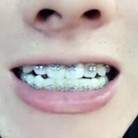 牙齿排列不整齐，在成都圣贝牙科医院做了牙齿正畸矫正缓解