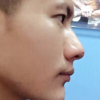 牙齿排列不整齐，在成都圣贝牙科医院做了牙齿正畸矫正缓解