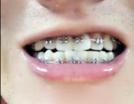 在成都圣贝牙科医院做了牙齿正畸矫正缓解