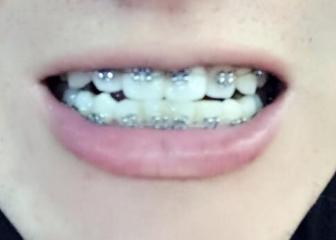 在成都圣贝牙科医院做了牙齿正畸矫正缓解