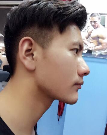 在成都圣贝牙科医院做了牙齿正畸矫正缓解