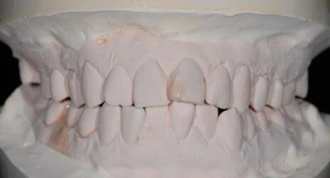 成都圣贝口腔医院做了全冠修复，牙齿排齐美白前后对比果图