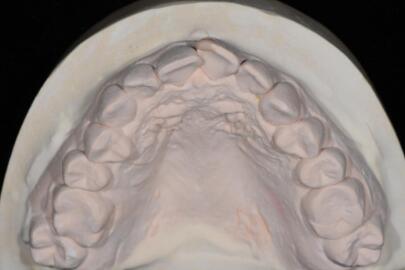 成都圣贝口腔医院做了全冠修复，牙齿排齐美白前后对比果图