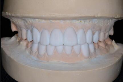 成都圣贝口腔医院做了全冠修复，牙齿排齐美白前后对比果图