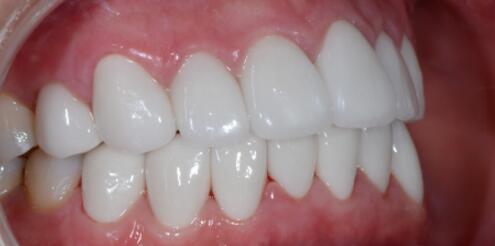 成都圣贝口腔医院做了全冠修复，牙齿排齐美白前后对比果图