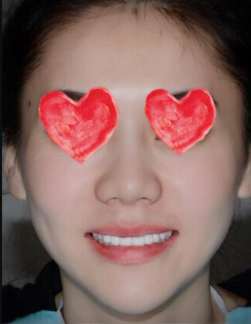 成都圣贝口腔医院做了全冠修复，牙齿排齐美白前后对比果图