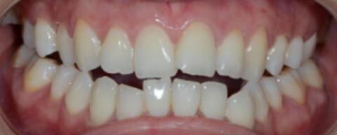 成都圣贝口腔医院做了全冠修复，牙齿排齐美白前后对比果图