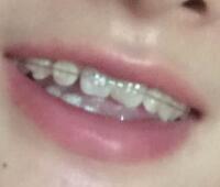 戴隐形牙套矫正牙齿前后对比图——成都圣贝牙科医院