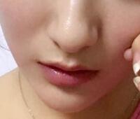 戴隐形牙套矫正牙齿前后对比图——成都圣贝牙科医院