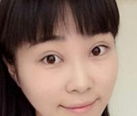 时光整形医院做的割双眼皮手术价格5200元 双眼皮对比图恢复过程