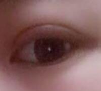 切开双眼皮+开眼角手术前后对比图恢复过程 昆山时光整形医院