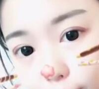 切开双眼皮+开眼角手术前后对比图恢复过程 昆山时光整形医院
