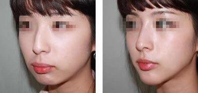 鹰钩鼻整形前后对比图