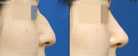 鹰钩鼻整形前后对比图