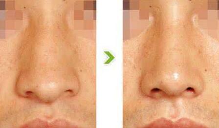 鹰钩鼻整形前后对比图