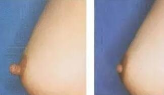乳头乳晕缩小前后对比图