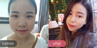 隆鼻整形前后对比图