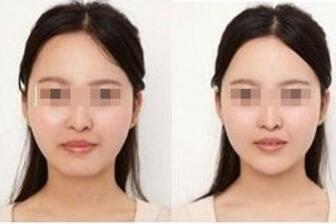 垫下巴前后对比图，垫下巴多少钱？
