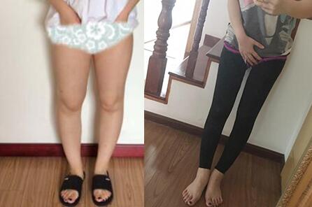 北京大腿吸脂减肥多少钱？哪家整形医院好？正规医院推荐