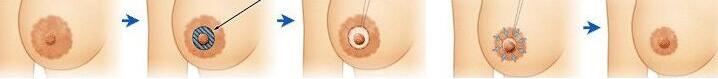 乳晕乳头缩小对比图,乳晕缩小原理图