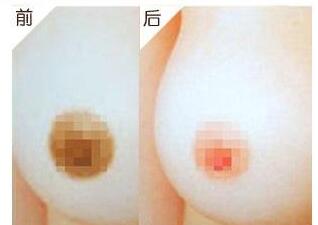 乳晕乳头缩小对比图,乳晕飘红