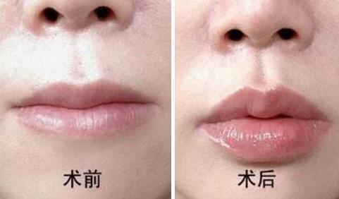 丰唇前后对比图，上海丰唇手术多少钱？
