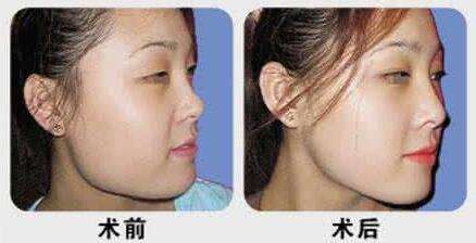 下颌角整形前后对比图
