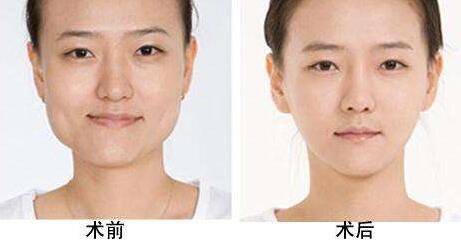 磨下颌角整形前后对比图