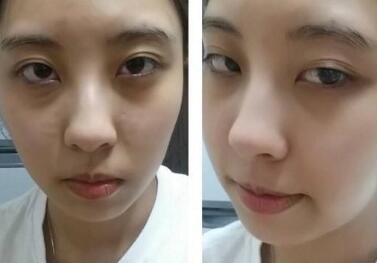 眼袋整形前后对比图