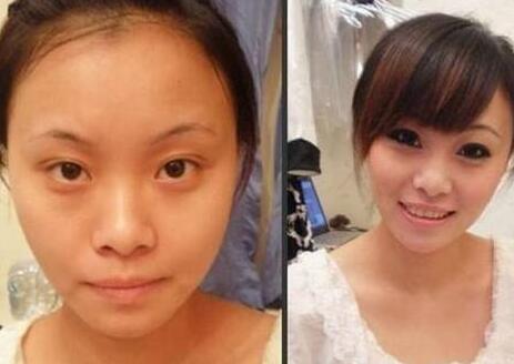 眼袋整形前后对比图