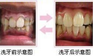 超声波吸烟前后对比图