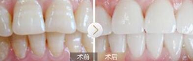 洗牙前后对比图