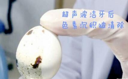洗牙疼吗?超声波洗牙多少钱一次
