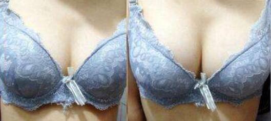 隆胸图片