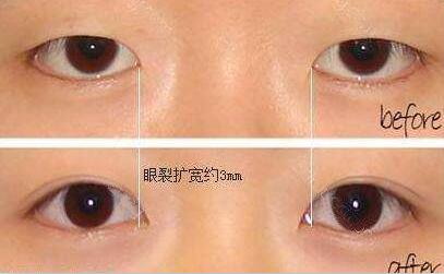 割双眼皮+开眼角前后对比图