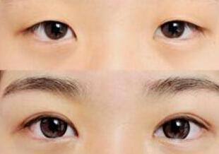双眼皮果是永.久性的吗