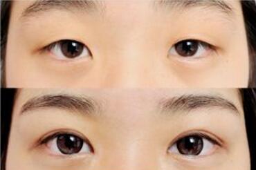 双眼皮整形图片
