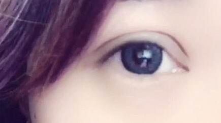 割双眼皮割宽了能变窄吗?图片