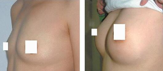 自体脂肪丰胸需要注射几次?