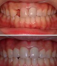 种植牙前后对比图，种植牙的利与弊