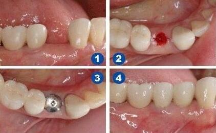 种植牙什么时候做好？