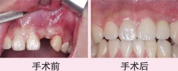 种植牙前后对比果图,种植牙寿命多长