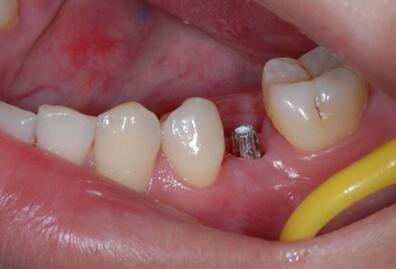 北京种植牙价格是多少