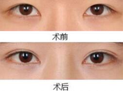埋线双眼皮好不好？果图