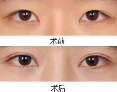埋线双眼皮果图
