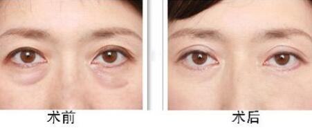 去眼袋前后对比图图片