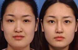 自体软骨隆鼻多少钱?适合哪些人?手术流程是什么?