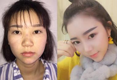隆鼻图片，隆鼻有哪几种方式?多少钱?隆鼻价格受什么因素影响?